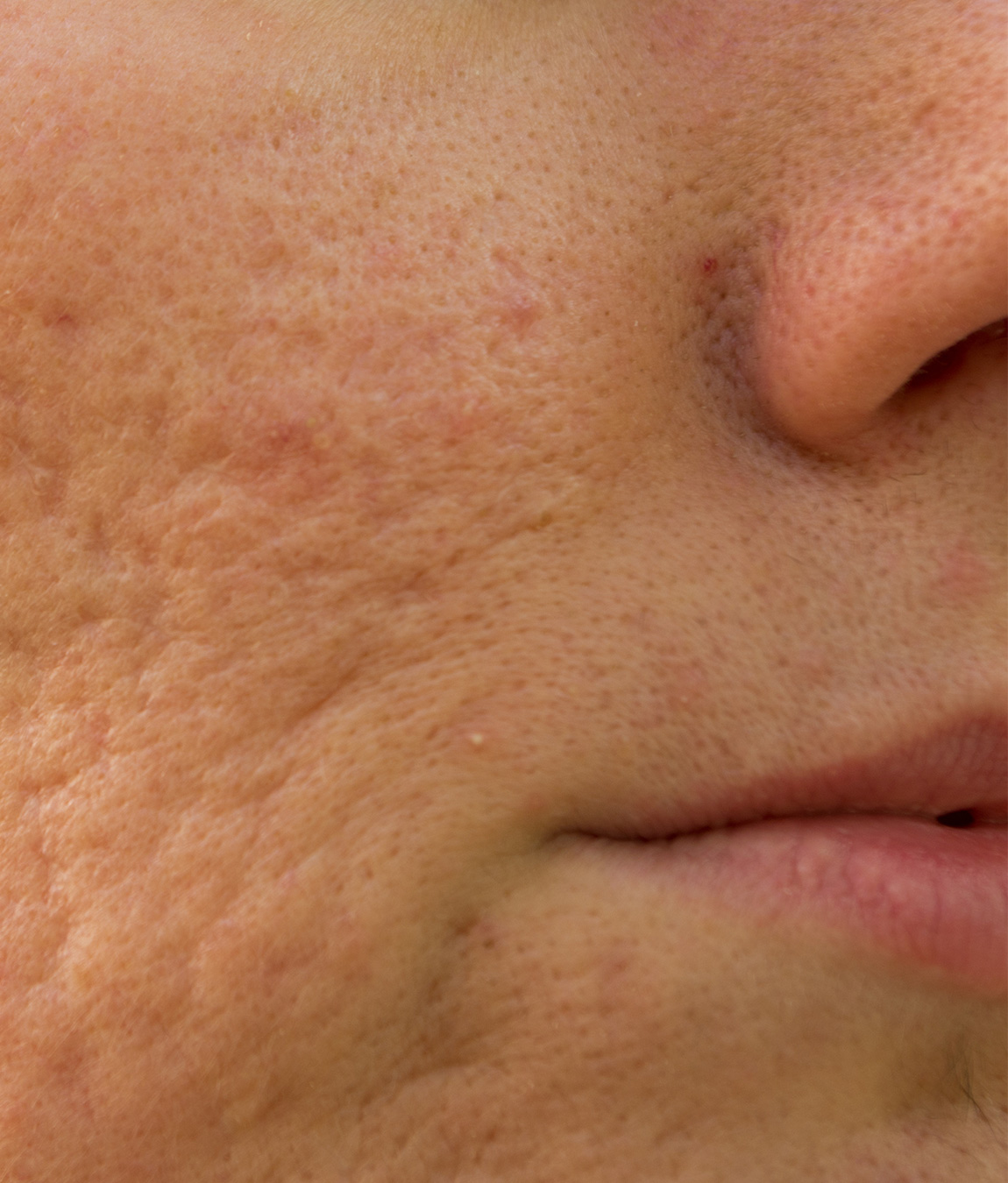 Close-up on facial acne and scars