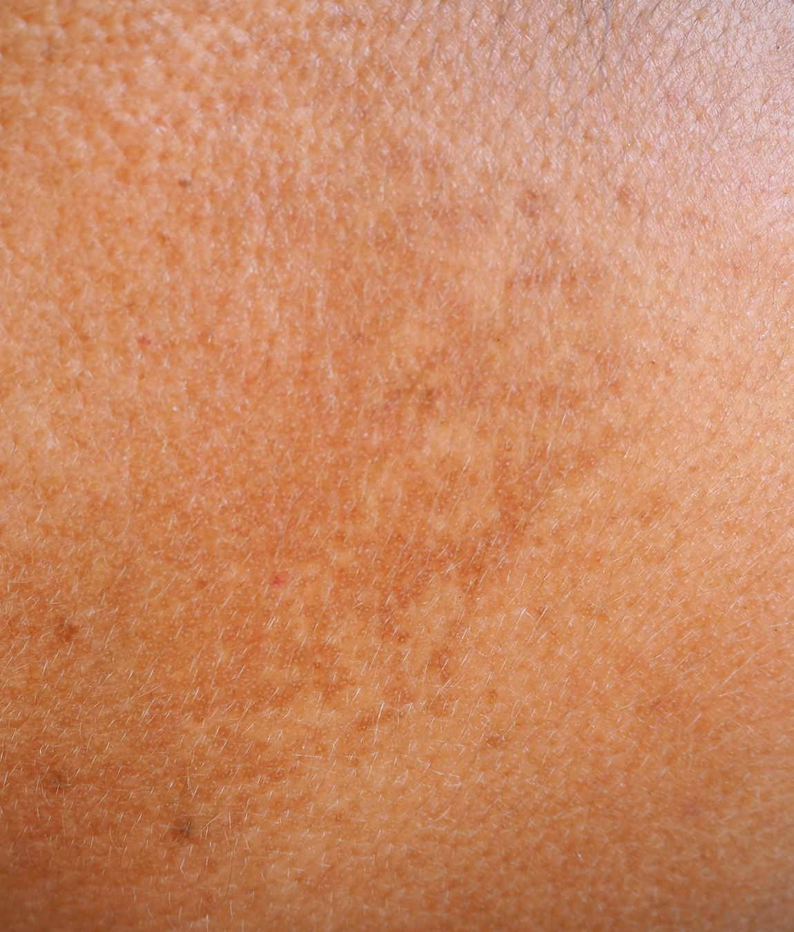 Close-up on hyperpigmentation