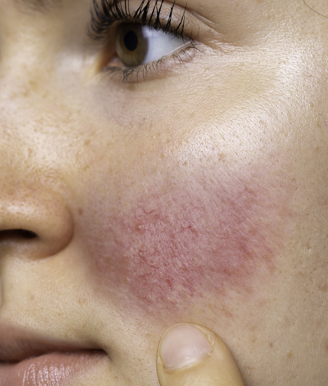 Close-up of rosacea on a woman's cheek