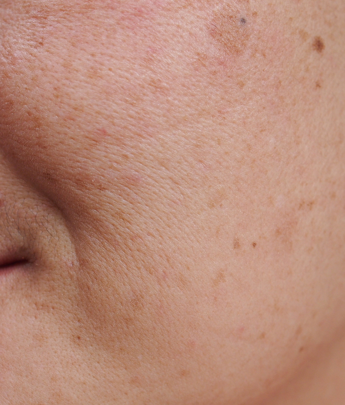 Close-up on sun damage on a person's face